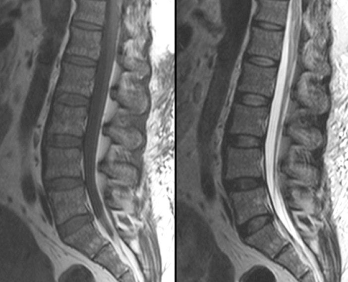 normal-sagittal-mri